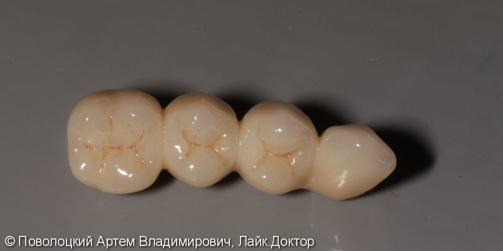 Протезирование жевательной группы зубов справа на имплантатах Osstem, коронки из диоксида циркония - фото №8