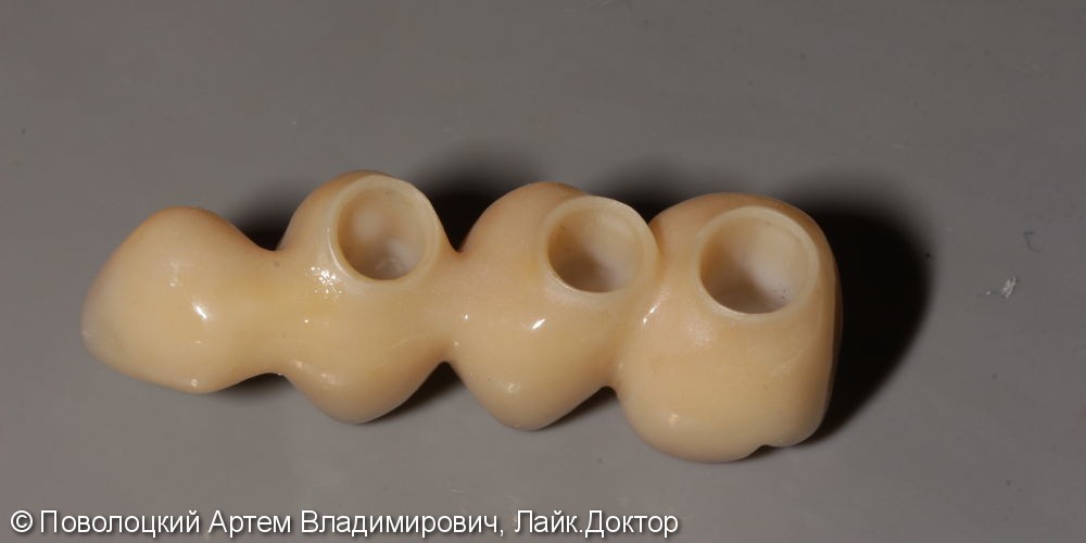 Протезирование жевательной группы зубов справа на имплантатах Osstem, коронки из диоксида циркония - фото №9