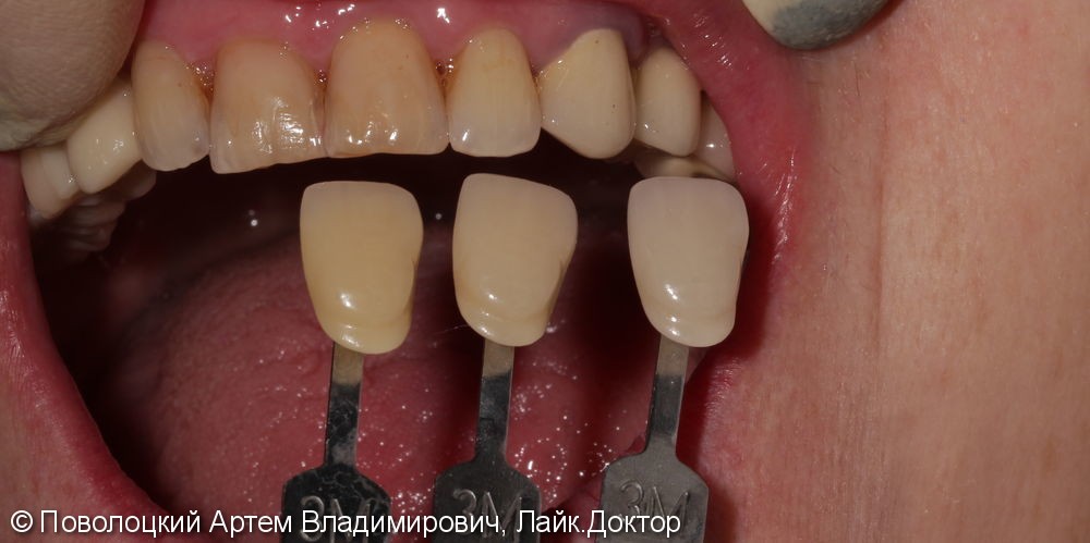 Протезирование жевательной группы зубов справа на имплантатах Osstem, коронки из диоксида циркония - фото №11