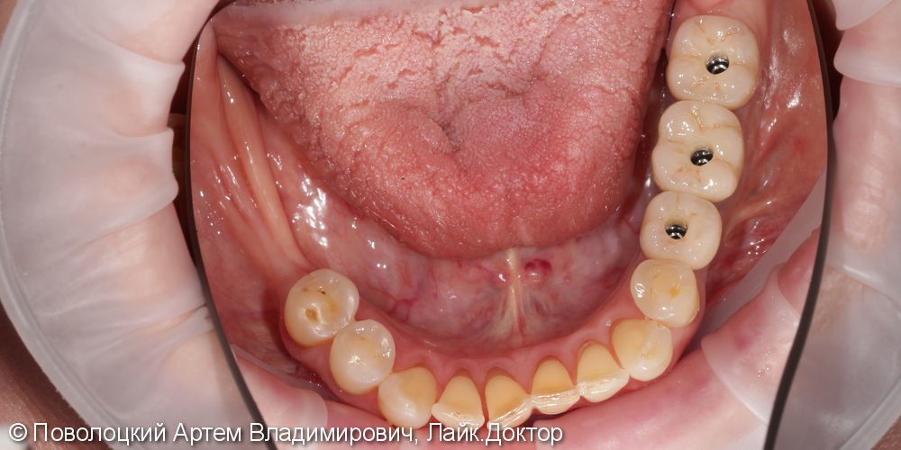 Протезирование жевательной группы зубов справа на имплантатах Osstem, коронки из диоксида циркония - фото №13