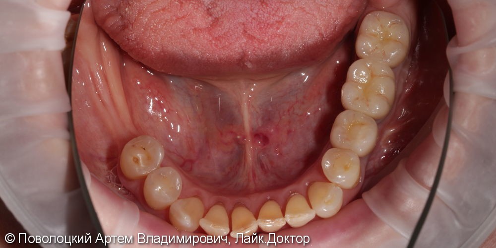 Протезирование жевательной группы зубов справа на имплантатах Osstem, коронки из диоксида циркония - фото №14