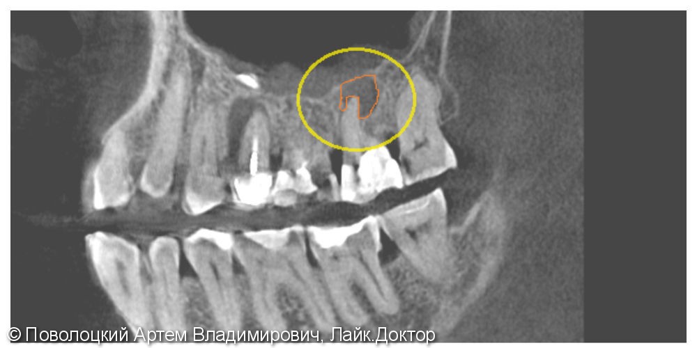 Лечение периапекального воспаления на 17 зубе, фото до и после - фото №1