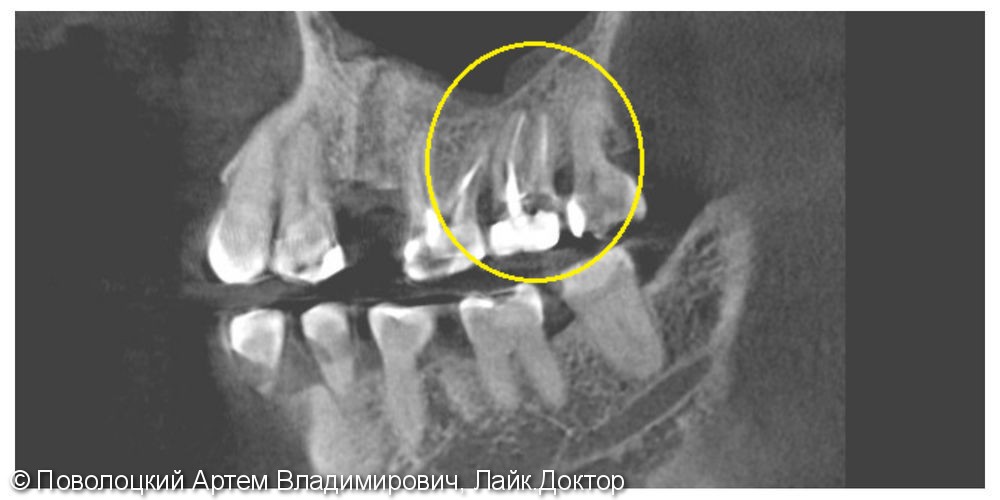 Лечение периапекального воспаления на 17 зубе, фото до и после - фото №2