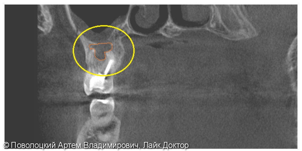 Лечение периапекального воспаления на 17 зубе, фото до и после - фото №3