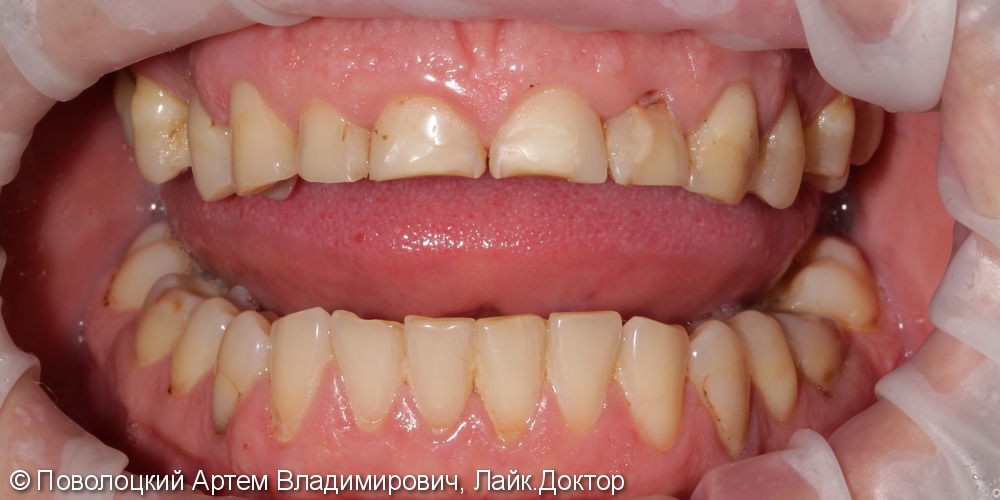 Керамические виниры E-max (6 единиц) на фронтальную группу зубов верхней челюсти. - фото №2