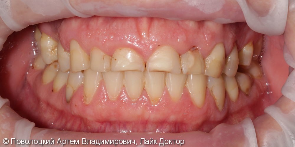 Керамические виниры E-max (6 единиц) на фронтальную группу зубов верхней челюсти. - фото №3