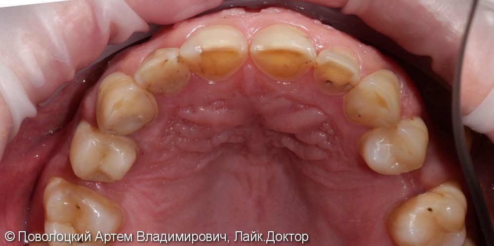 Керамические виниры E-max (6 единиц) на фронтальную группу зубов верхней челюсти. - фото №4