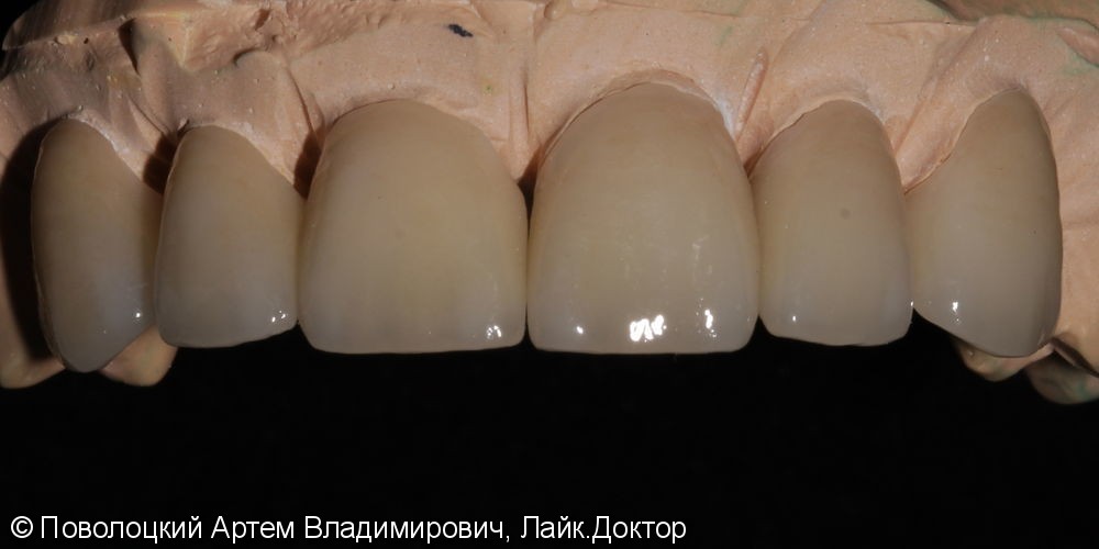 Керамические виниры E-max (6 единиц) на фронтальную группу зубов верхней челюсти. - фото №5
