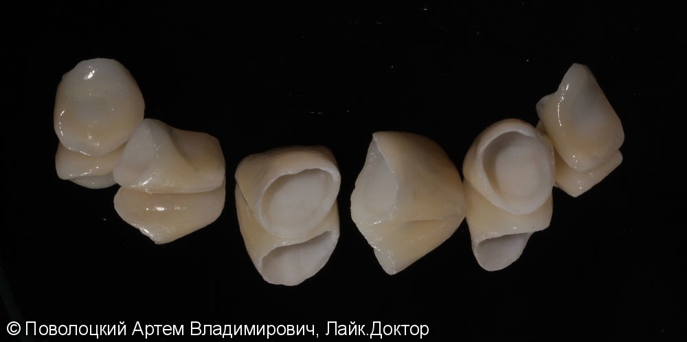 Керамические виниры E-max (6 единиц) на фронтальную группу зубов верхней челюсти. - фото №6