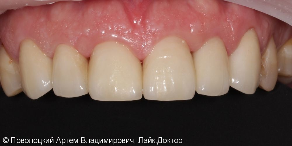 Керамические виниры E-max (6 единиц) на фронтальную группу зубов верхней челюсти. - фото №7
