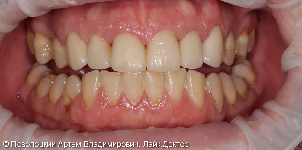 Керамические виниры E-max (6 единиц) на фронтальную группу зубов верхней челюсти. - фото №8