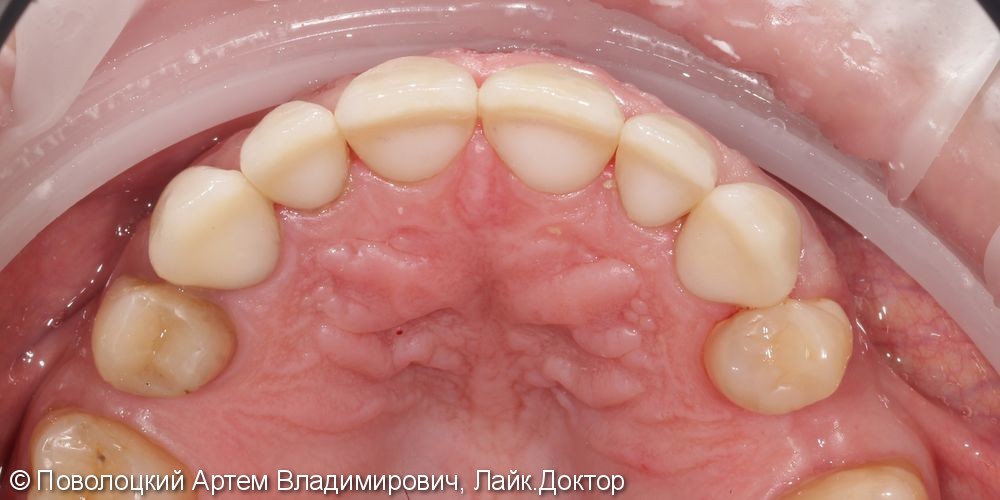 Керамические виниры E-max (6 единиц) на фронтальную группу зубов верхней челюсти. - фото №9