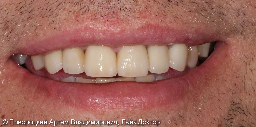 Керамические виниры E-max (6 единиц) на фронтальную группу зубов верхней челюсти. - фото №10