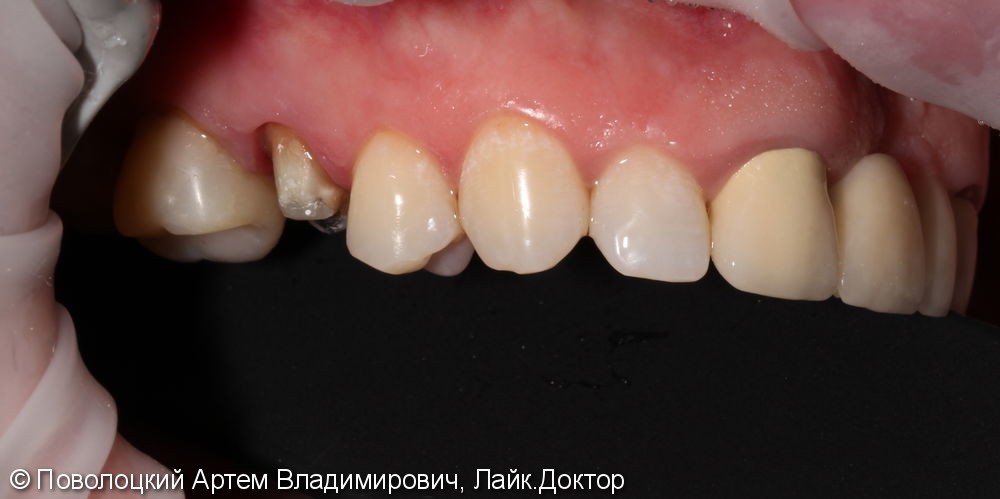 Покрытие 15 зуба безметалловой коронкой по технологии E-max - фото №3