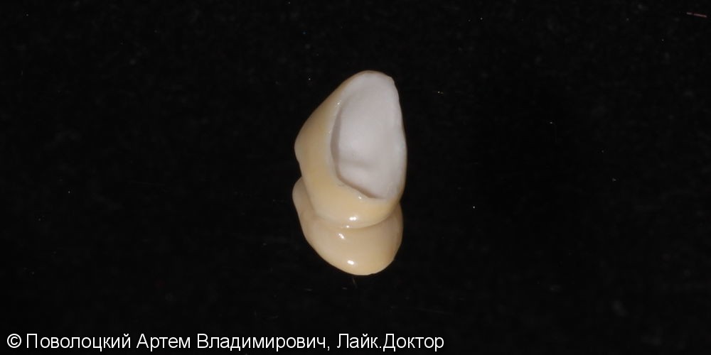 Покрытие 15 зуба безметалловой коронкой по технологии E-max - фото №7
