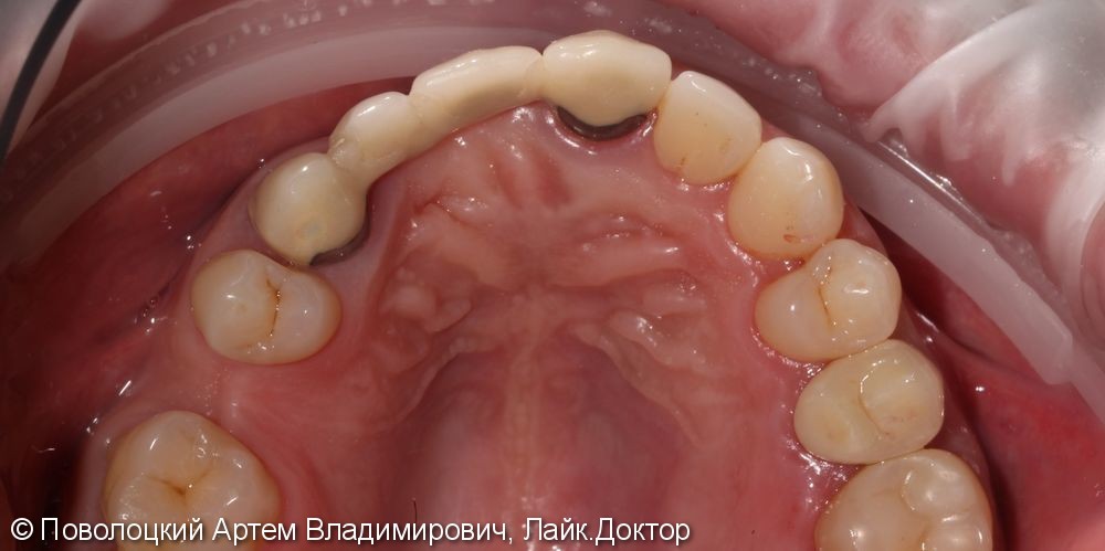 Покрытие 15 зуба безметалловой коронкой по технологии E-max - фото №9