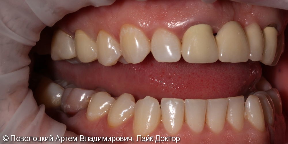 Покрытие 15 зуба безметалловой коронкой по технологии E-max - фото №10