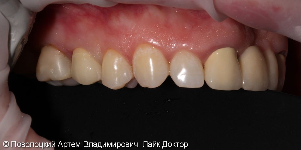Покрытие 15 зуба безметалловой коронкой по технологии E-max - фото №11