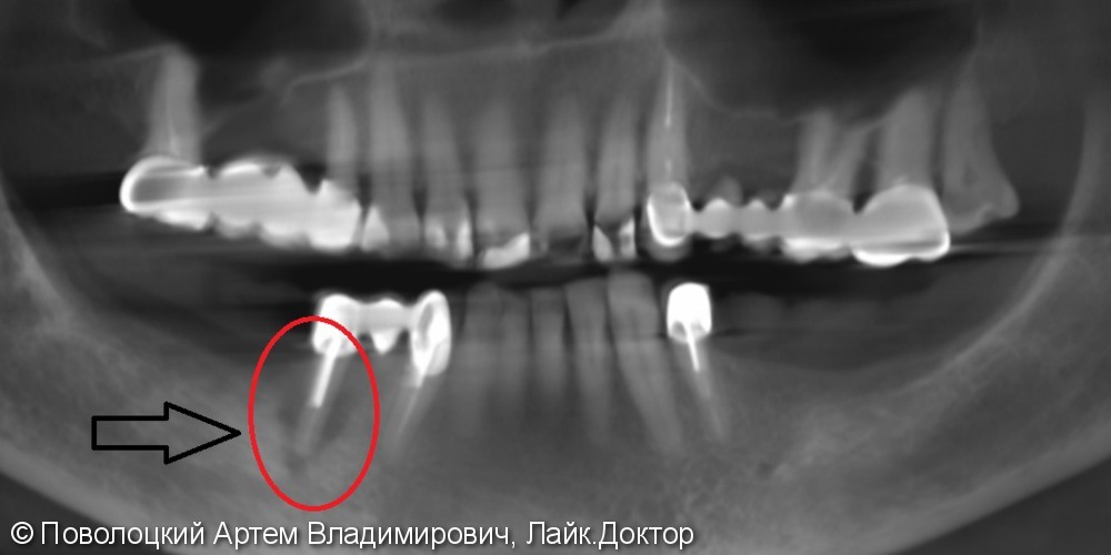 Протезирование  на нижней челюсти. Коронки на своих зубах и на имплантатах Osstem. 3д костная пластика. - фото №5