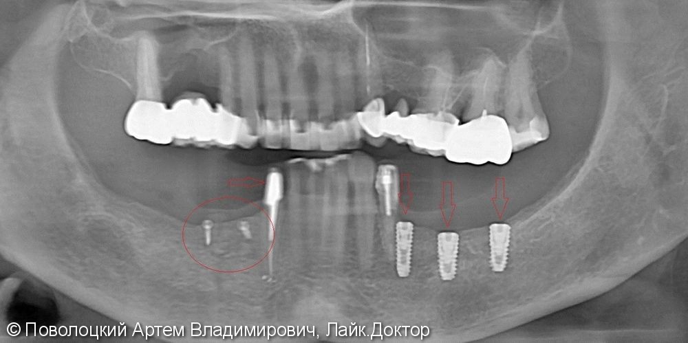 Протезирование  на нижней челюсти. Коронки на своих зубах и на имплантатах Osstem. 3д костная пластика. - фото №6