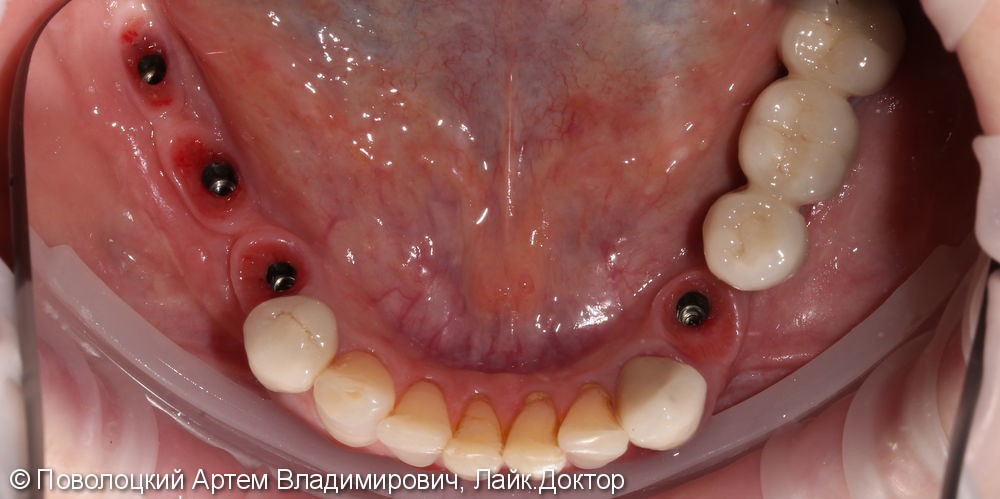 Протезирование  на нижней челюсти. Коронки на своих зубах и на имплантатах Osstem. 3д костная пластика. - фото №8