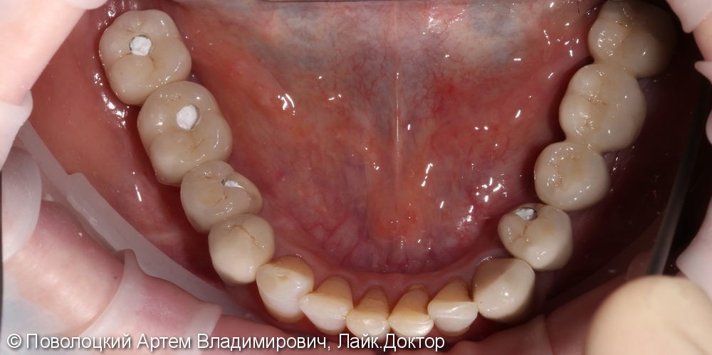Протезирование  на нижней челюсти. Коронки на своих зубах и на имплантатах Osstem. 3д костная пластика. - фото №9