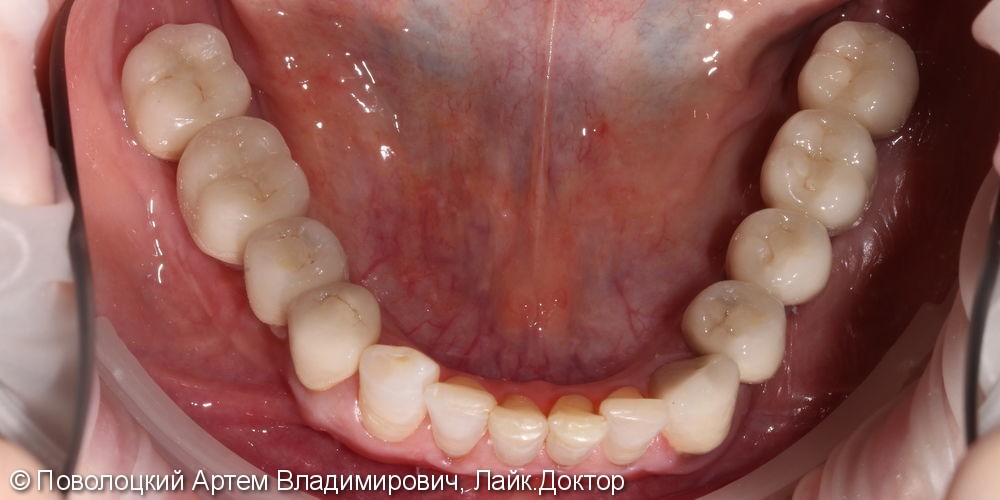 Протезирование  на нижней челюсти. Коронки на своих зубах и на имплантатах Osstem. 3д костная пластика. - фото №10