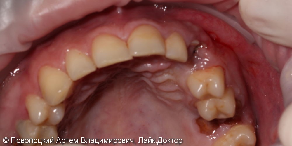 Удаление клыка слева и одномоментная имплантация Osstem с временной коронкой. - фото №1