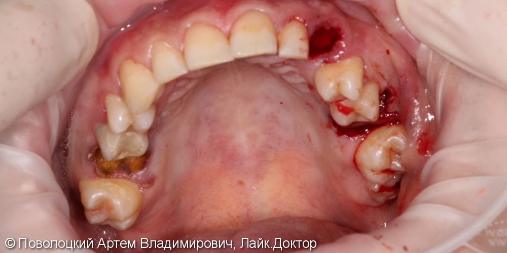 Удаление клыка слева и одномоментная имплантация Osstem с временной коронкой. - фото №3