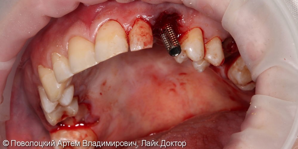 Удаление клыка слева и одномоментная имплантация Osstem с временной коронкой. - фото №6