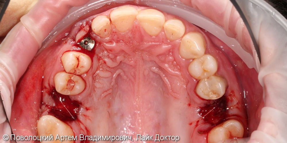 Удаление клыка слева и одномоментная имплантация Osstem с временной коронкой. - фото №11