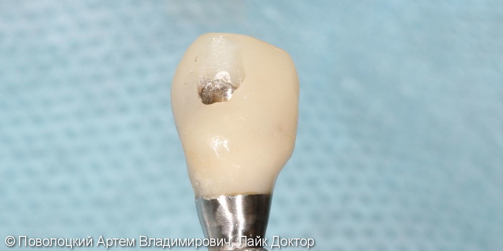 Удаление клыка слева и одномоментная имплантация Osstem с временной коронкой. - фото №13