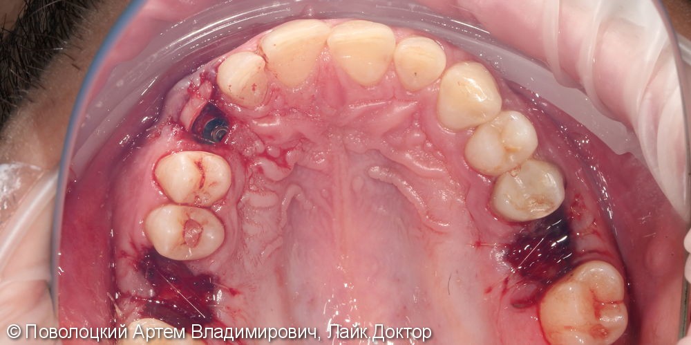 Удаление клыка слева и одномоментная имплантация Osstem с временной коронкой. - фото №15