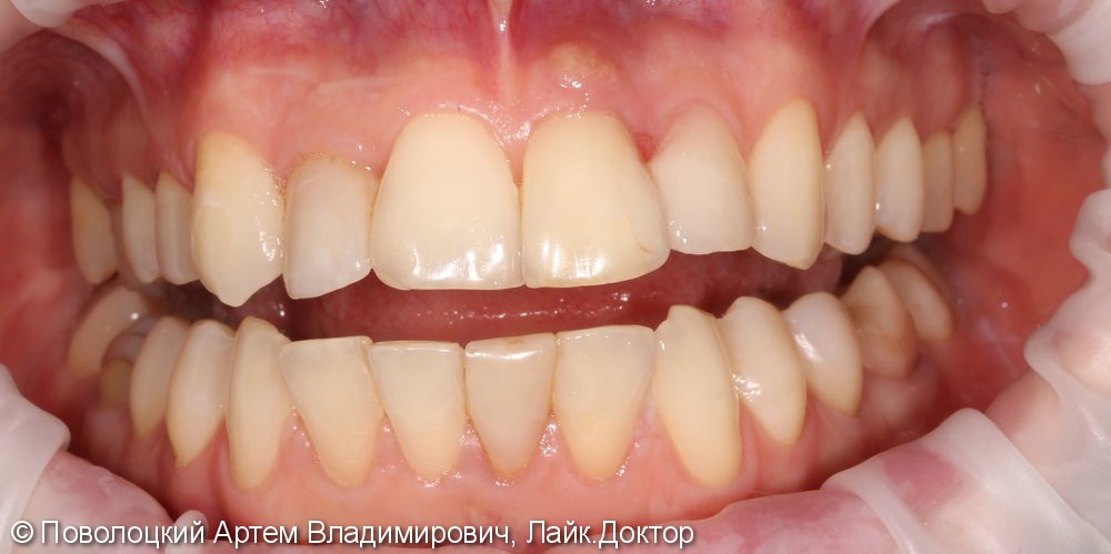 Одномоментная имплантация Осстем 12,21,22 после удаления зубов, цирконевые коронки на имплантатах и винир на 11 зубе - фото №1