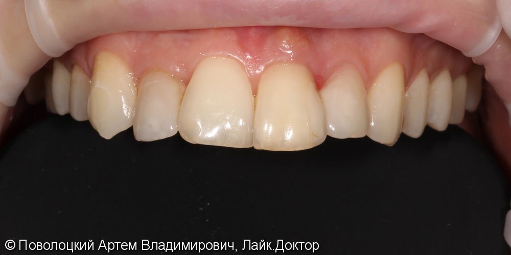Одномоментная имплантация Осстем 12,21,22 после удаления зубов, цирконевые коронки на имплантатах и винир на 11 зубе - фото №2