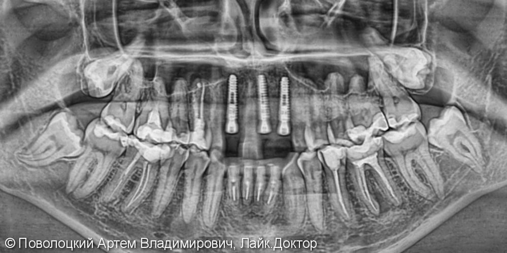 Одномоментная имплантация Осстем 12,21,22 после удаления зубов, цирконевые коронки на имплантатах и винир на 11 зубе - фото №4