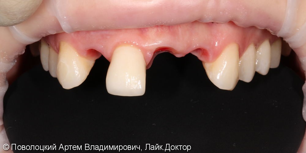Одномоментная имплантация Осстем 12,21,22 после удаления зубов, цирконевые коронки на имплантатах и винир на 11 зубе - фото №5