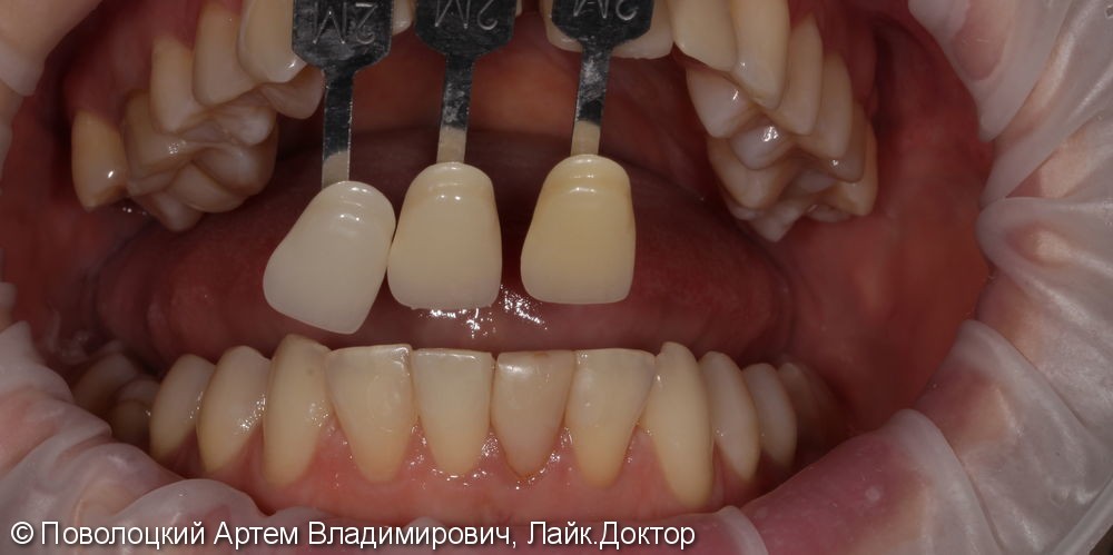 Одномоментная имплантация Осстем 12,21,22 после удаления зубов, цирконевые коронки на имплантатах и винир на 11 зубе - фото №6