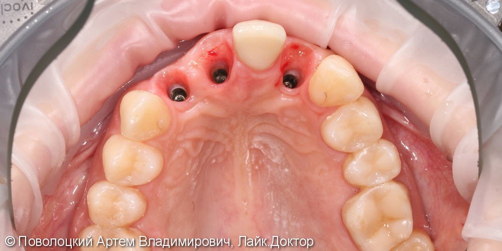 Одномоментная имплантация Осстем 12,21,22 после удаления зубов, цирконевые коронки на имплантатах и винир на 11 зубе - фото №7