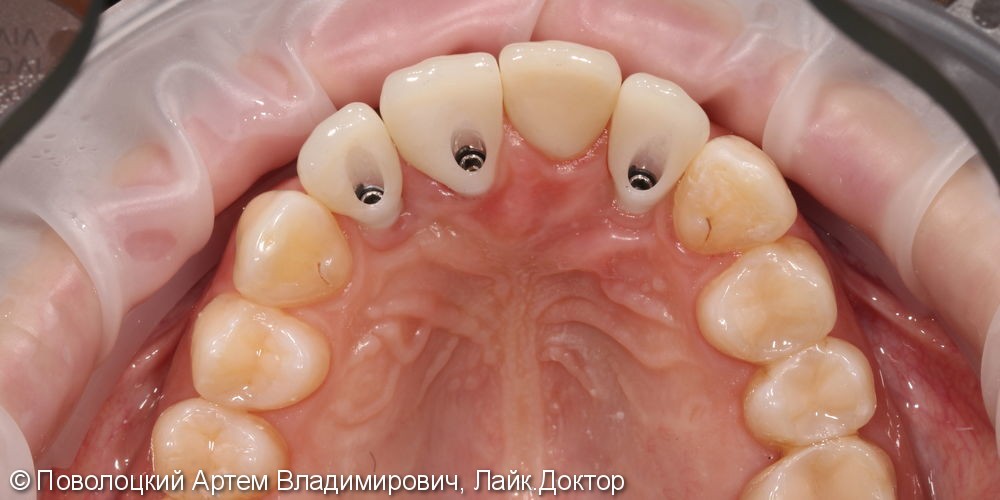 Одномоментная имплантация Осстем 12,21,22 после удаления зубов, цирконевые коронки на имплантатах и винир на 11 зубе - фото №9