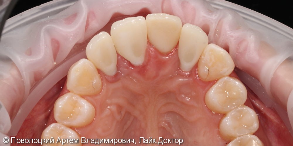 Одномоментная имплантация Осстем 12,21,22 после удаления зубов, цирконевые коронки на имплантатах и винир на 11 зубе - фото №10