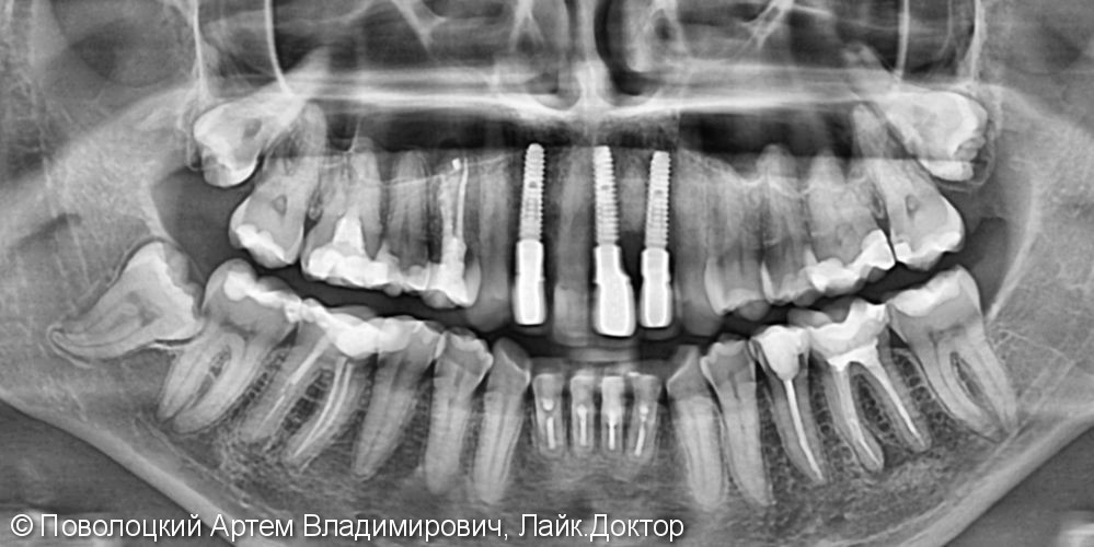 Одномоментная имплантация Осстем 12,21,22 после удаления зубов, цирконевые коронки на имплантатах и винир на 11 зубе - фото №11