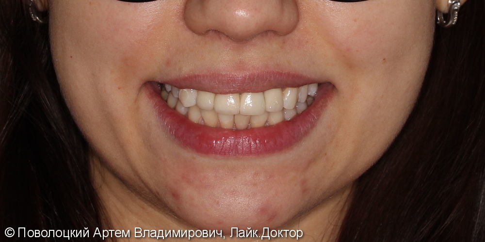 Одномоментная имплантация Осстем 12,21,22 после удаления зубов, цирконевые коронки на имплантатах и винир на 11 зубе - фото №12