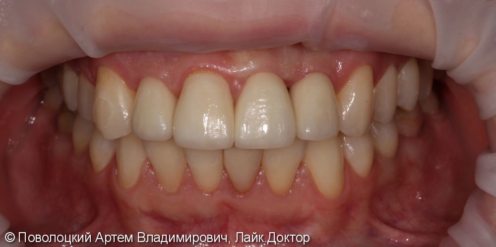 Одномоментная имплантация Осстем 12,21,22 после удаления зубов, цирконевые коронки на имплантатах и винир на 11 зубе - фото №13