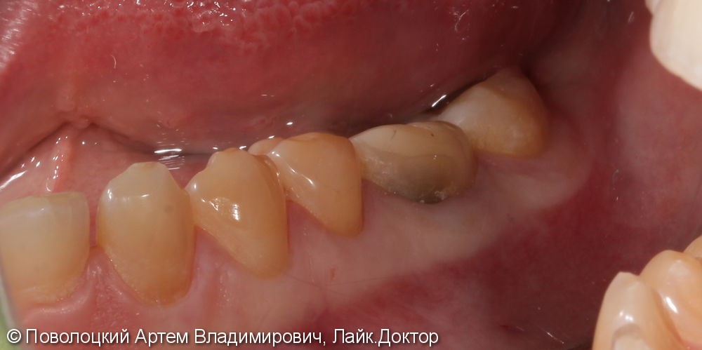 Покрытие зуба 46 коронкой безметалловой по технологии E-max - фото №2
