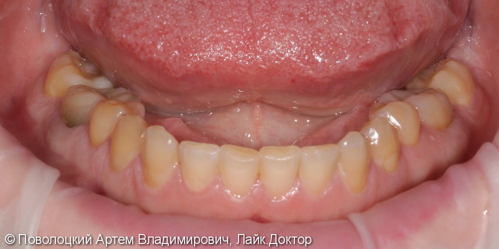 Покрытие зуба 46 коронкой безметалловой по технологии E-max - фото №3