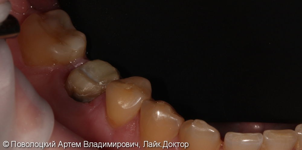 Покрытие зуба 46 коронкой безметалловой по технологии E-max - фото №4