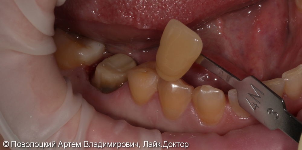 Покрытие зуба 46 коронкой безметалловой по технологии E-max - фото №5