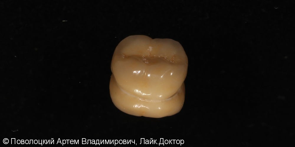 Покрытие зуба 46 коронкой безметалловой по технологии E-max - фото №6