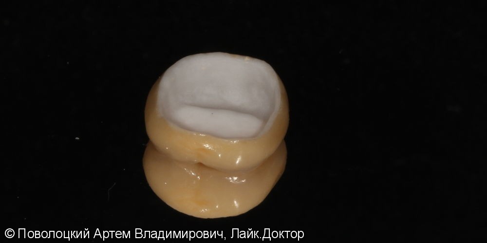 Покрытие зуба 46 коронкой безметалловой по технологии E-max - фото №7